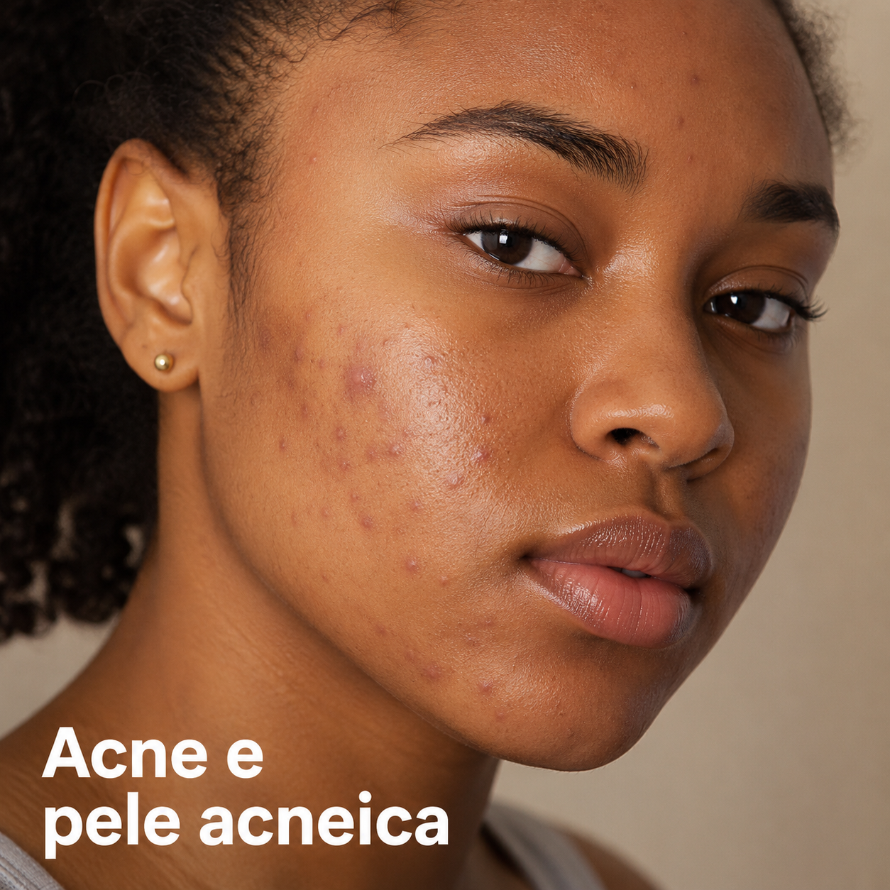 Acne e Pele Acneica